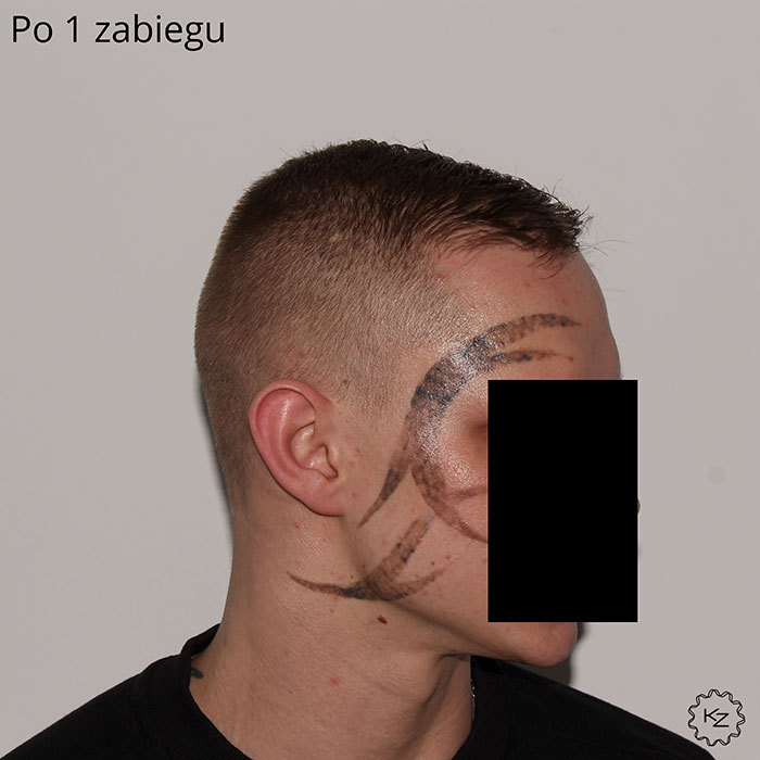 usuwanie laserowe tatuażu